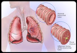 obat tradisional penyakit bronkitis secara alami